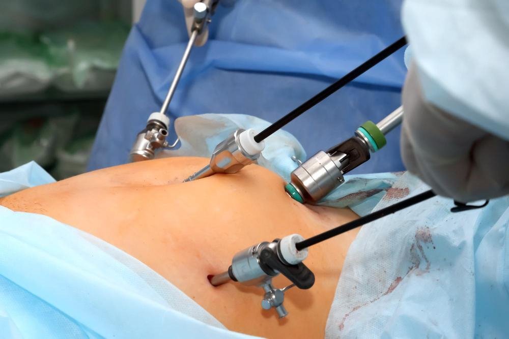 Laparoscopic Appendectomy