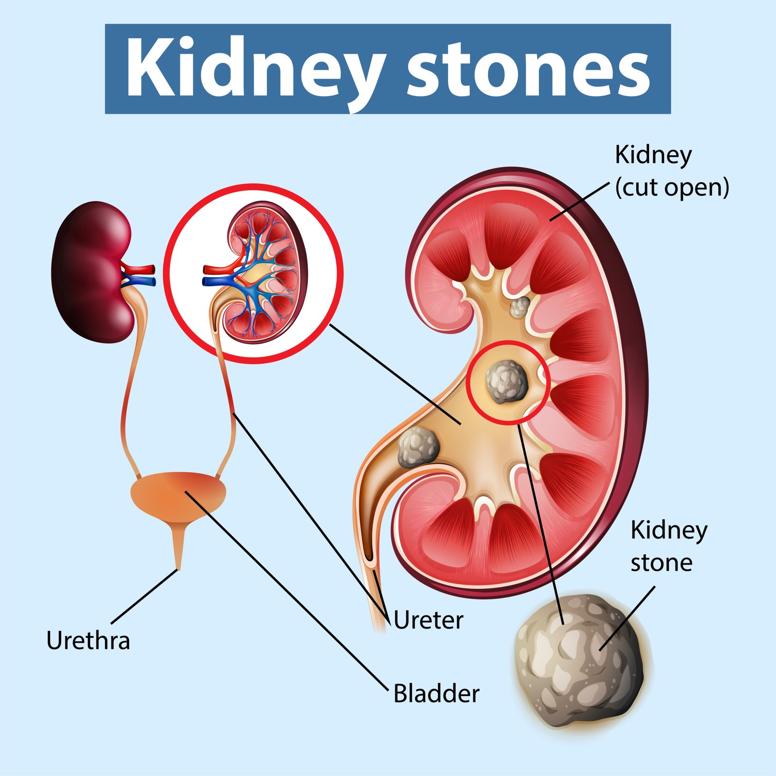 PCNL for Kidney Stones