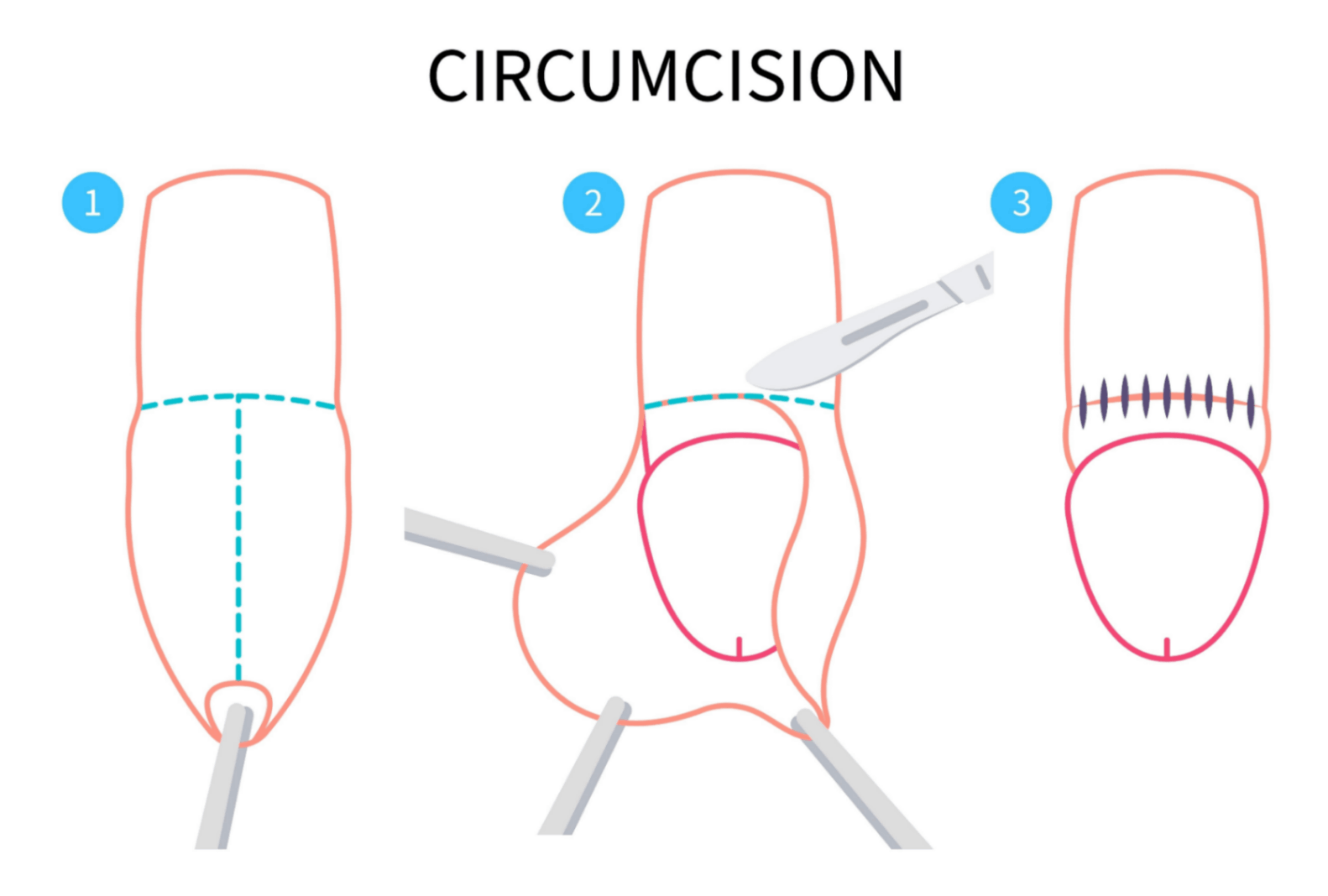 Phimosis and Paraphimosis Surgery