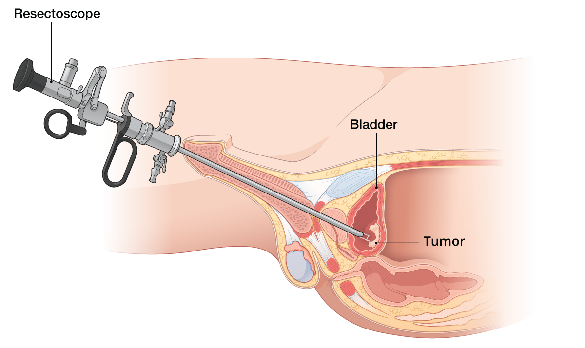 TURBT for Urinary Bladder Tumor