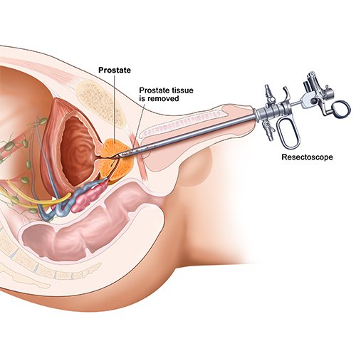 TURP for Prostate Enlargement