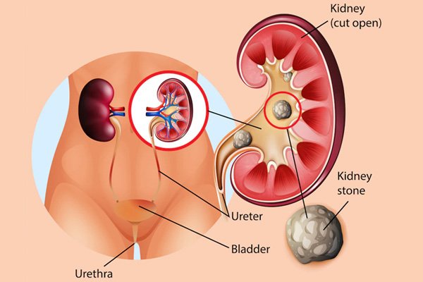 Ureteroscopy for Ureter Stone