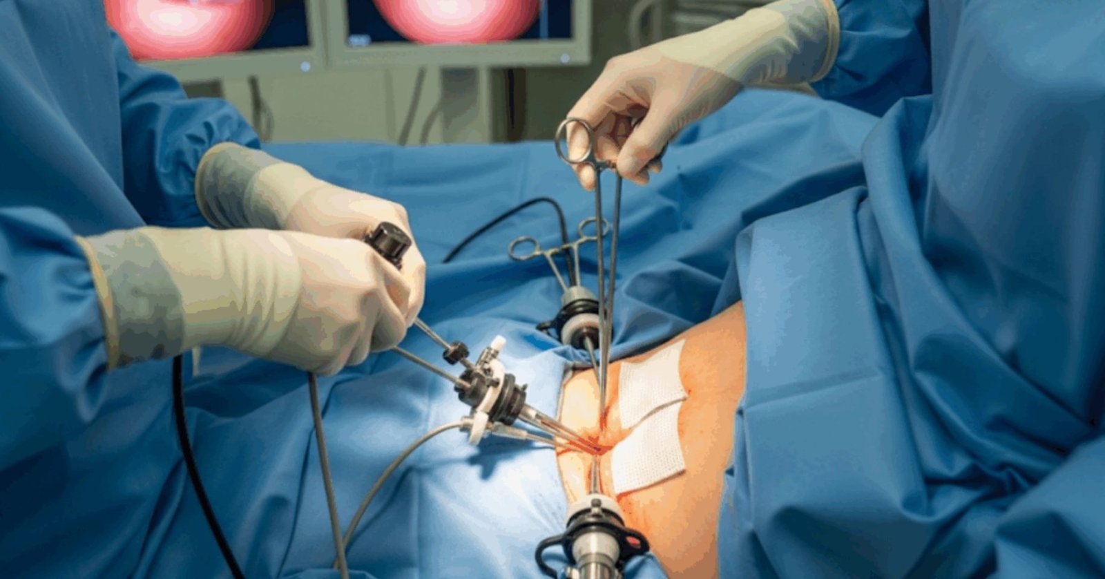 Laparoscopic Hernia Surgery